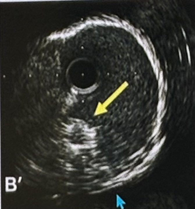 Alejandro Lara García (@azlaragarcia) on Twitter photo Algunos ''souvenirs'' del I curso de Fisiología e Imagen Intracoronaria de la <a href="/secardiologia/">Soc Esp Cardiología</a> <a href="/shci_sec/">ACI-SEC: Hemodinamica</a>
💡Genial iniciativa para hacer el ojo en imágenes difíciles
Nos vemos el año que viene <a href="/fer_iver/">Fernando Rivero</a> <a href="/teresabastante/">Teresa Bastante</a> <a href="/EvaRumiz/">Eva Rumiz</a> Algunos ''souvenirs'' del I curso de Fisiología e Imagen Intracoronaria de la <a href="/secardiologia/">Soc Esp Cardiología</a> <a href="/shci_sec/">ACI-SEC: Hemodinamica</a>
💡Genial iniciativa para hacer el ojo en imágenes difíciles
Nos vemos el año que viene <a href="/fer_iver/">Fernando Rivero</a> <a href="/teresabastante/">Teresa Bastante</a> <a href="/EvaRumiz/">Eva Rumiz</a>