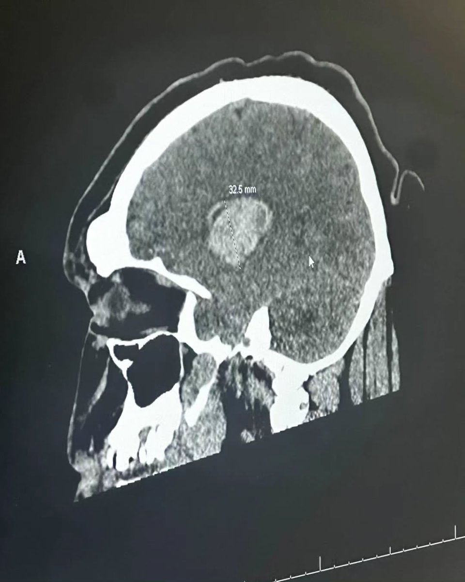 xray of my skull

i almost died that day.

thankful to all my followers and God and parkour and fortnite ❤️