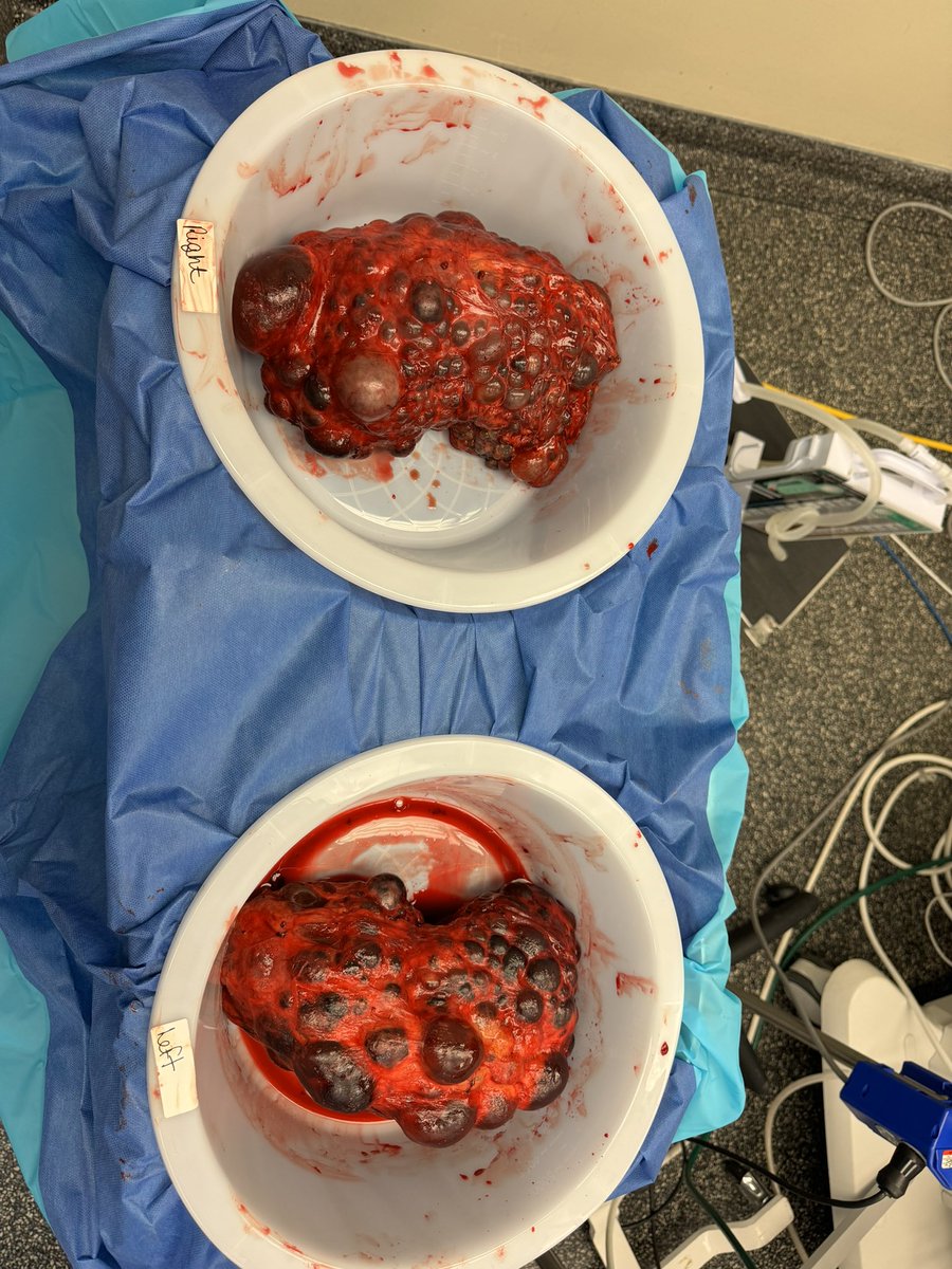 Today was a great day! Drs. Juneau (PGY5) and Ogundipe (PGY2) helped perform open bilateral simple nephrectomies on a patient with Polycystic Kidney Disease. Dr. Ankem’s still got it 💪🏻 #PKD #nephrectomy #cystseverywhere #uoflurology