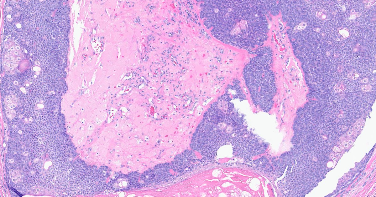 Henry YANG (@henryy_md) on Twitter photo #dermpath
TGIF! Have fun with this beautiful lesion...what is your Dx?
50 yo M. Back. clinical Cyst
<a href="/mccalmo/">Tim McCalmont</a> <a href="/david_terrano/">David Terrano</a> <a href="/et565/">Etan Marks, DO</a> <a href="/tonitatirado/">Mariantonieta Tirado</a> <a href="/gonzadetoro/">Gonzalo De Toro</a> <a href="/MarcelaSaebL/">Marcelasaeblima.</a> <a href="/SGottesmanMD/">Silvija Gottesman MD</a> <a href="/glinglerimek/">gulcin guler simsek, MD</a> <a href="/ASDPTweets/">American Society of Dermatopathology</a> <a href="/pembeoltulu/">Pembe Oltulu, MD</a> <a href="/kis_lorand/">Lorand Kis</a> <a href="/DrGeeONE/">Olaleke Folaranmi</a> <a href="/pepeheffernan/">Pepe Jiménez Heffernan</a> <a href="/ChristineJKoMD/">Christine J. Ko, MD</a> #dermpath
TGIF! Have fun with this beautiful lesion...what is your Dx?
50 yo M. Back. clinical Cyst
<a href="/mccalmo/">Tim McCalmont</a> <a href="/david_terrano/">David Terrano</a> <a href="/et565/">Etan Marks, DO</a> <a href="/tonitatirado/">Mariantonieta Tirado</a> <a href="/gonzadetoro/">Gonzalo De Toro</a> <a href="/MarcelaSaebL/">Marcelasaeblima.</a> <a href="/SGottesmanMD/">Silvija Gottesman MD</a> <a href="/glinglerimek/">gulcin guler simsek, MD</a> <a href="/ASDPTweets/">American Society of Dermatopathology</a> <a href="/pembeoltulu/">Pembe Oltulu, MD</a> <a href="/kis_lorand/">Lorand Kis</a> <a href="/DrGeeONE/">Olaleke Folaranmi</a> <a href="/pepeheffernan/">Pepe Jiménez Heffernan</a> <a href="/ChristineJKoMD/">Christine J. Ko, MD</a>