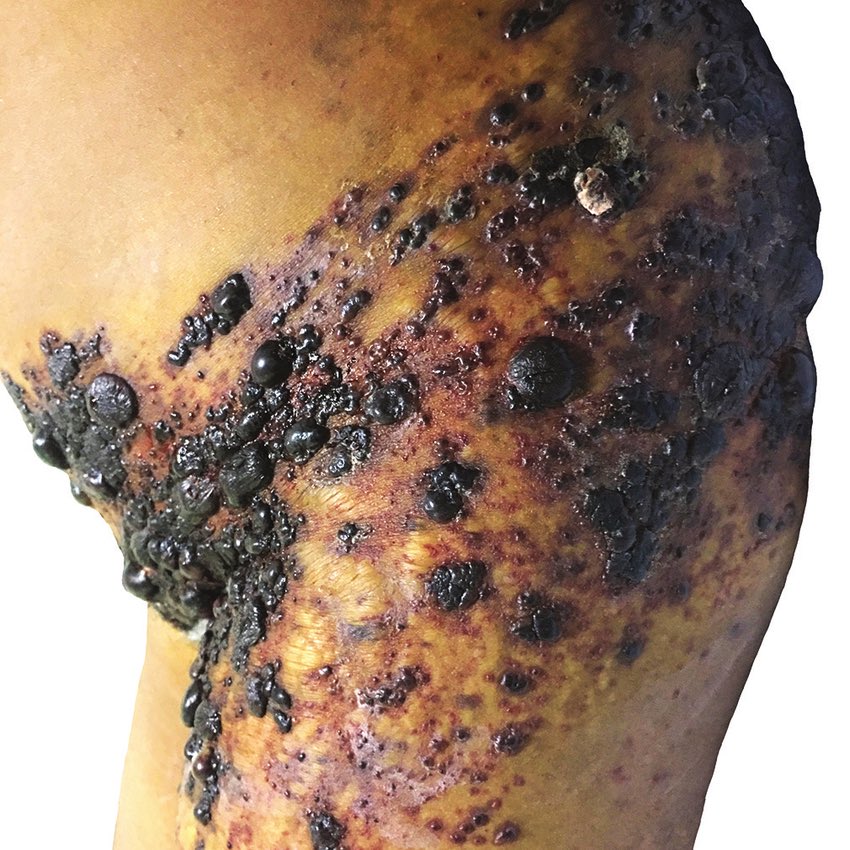 What is the diagnosis?

#MEDHM #MedX <a href="/IhabFathiSulima/">Dr Ihab Suliman</a>