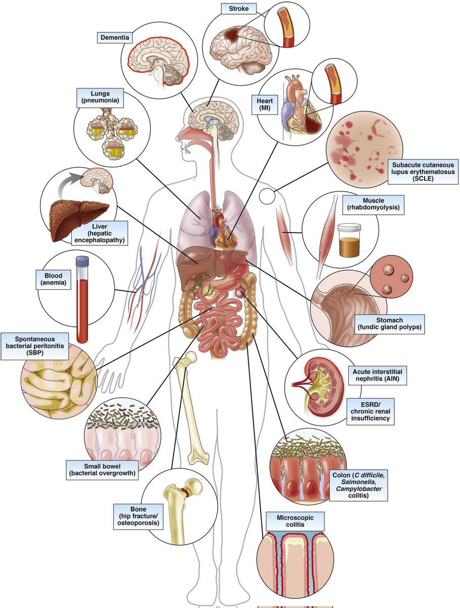 drsthanus's tweet photo. Complications of Proton Pump Inhibitor Therapy

Schematic diagram of some of the reported adverse consequences of long-term PPI therapy

https://t.co/5YYwynUjkN https://t.co/i0zo3pyY4C