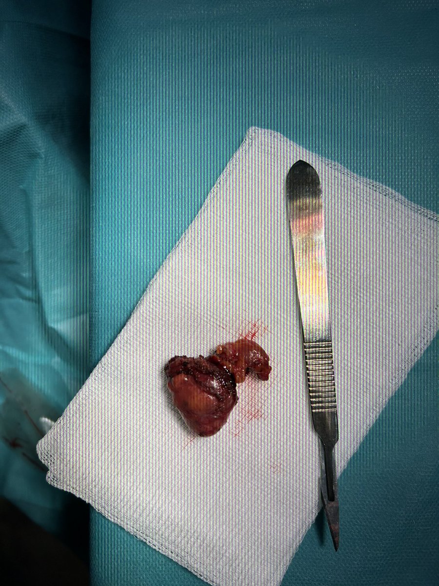 IonPerciuleac's tweet photo. Robotic- assisted enucleoresection of right renal tumour https://t.co/TitL4tQ07I