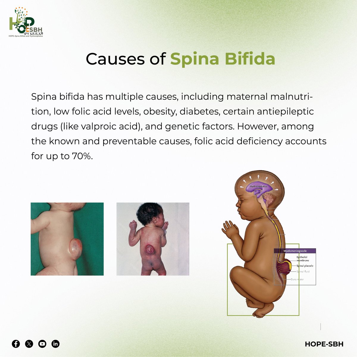 HOPEsbh's tweet photo. #HOPR #MOH #MoWSA #PMO #OFLEthiopia #MoI #BMGF #UNICEF #GAIN #NI #IFglobal #CHI #fhi360 #AddisGuzo #HOPESBH #SpinaBifidaHydrocephalusAwarenes #FolicAcid #MaternalHealth #SpinaBifida #Hydrocephalus #Advocacy #CommunityHealth #InclusiveSociety #BehavioralChange #RAF #Ethiopia #EBS https://t.co/M4TugdXSX0
