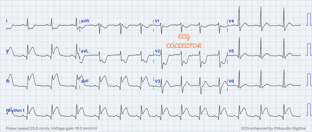 Young gentleman at 39 y.o with chest pain; 

How many areas are involved here❓🤔

<a href="/PMcardioApp/">PMcardio—AI that reads ECGs</a> 
<a href="/LITFLblog/">LITFL</a> 
#Cardiology 
#CardioTwitter 
#CardioEd 
#Medicalstudent 
#Medtwitter