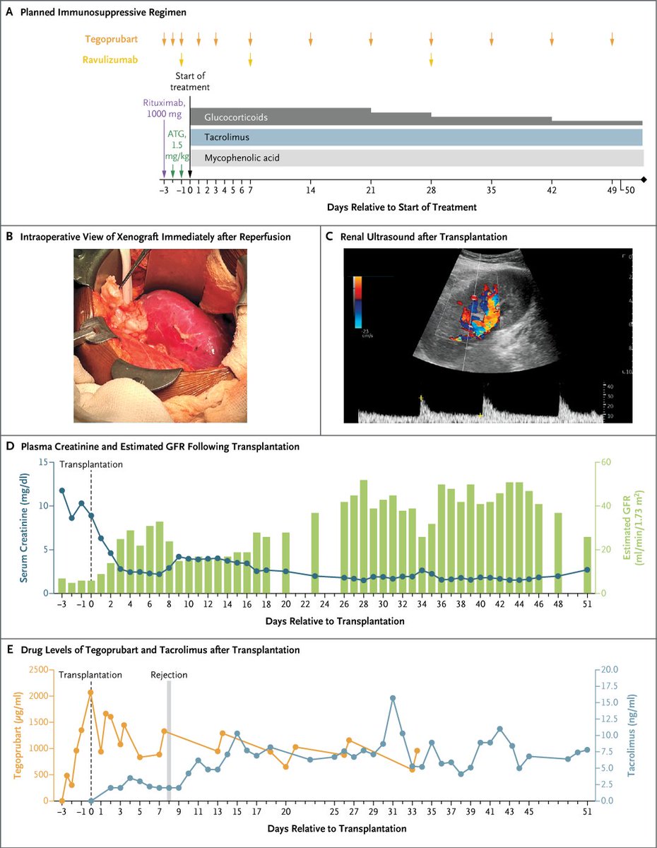 Original Article: Xenotransplantation of Porcine Kidney for End-Stage Kidney Disease nej.md/3Esayoz 

#ISNWCN | <a href="/ISNWCN/">World Congress of Nephrology</a>