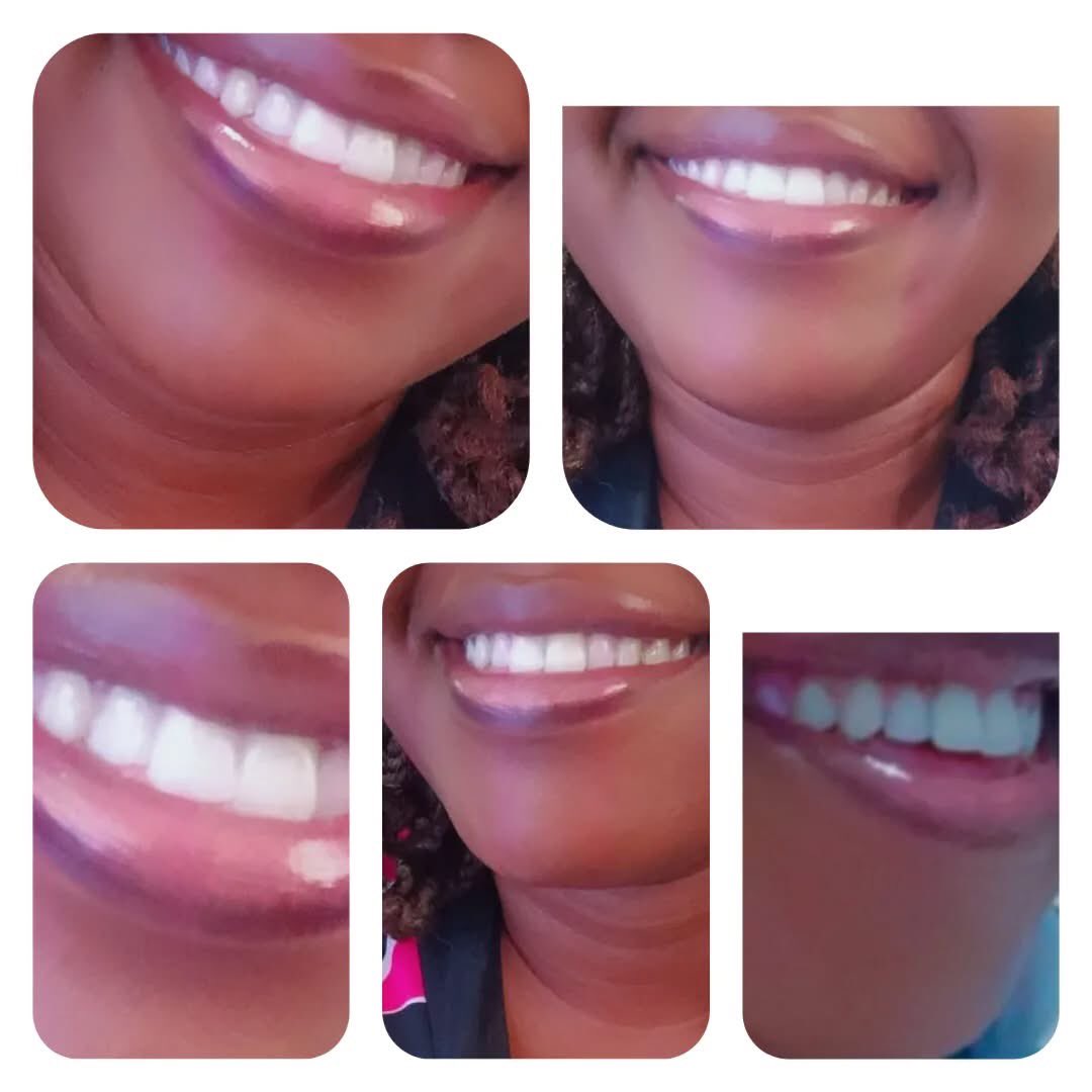 CAL_Dental's tweet photo. Smile ,you are on Camera , But what if you are not confident in your smile ? Our Dental Clinic is here to help. From teeth cleaning to Orthodontics, we have got you covered 
#CAL Dental clinic
 #Smile make over 😊😁
#dentalcheckup
#0774616406 https://t.co/rJA8GfHQlj