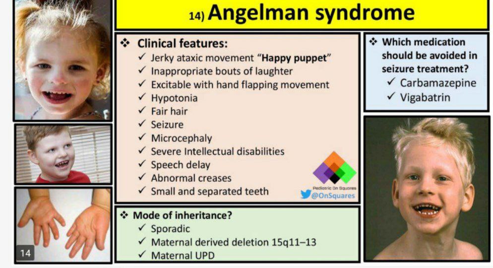Angelman Syndrome...