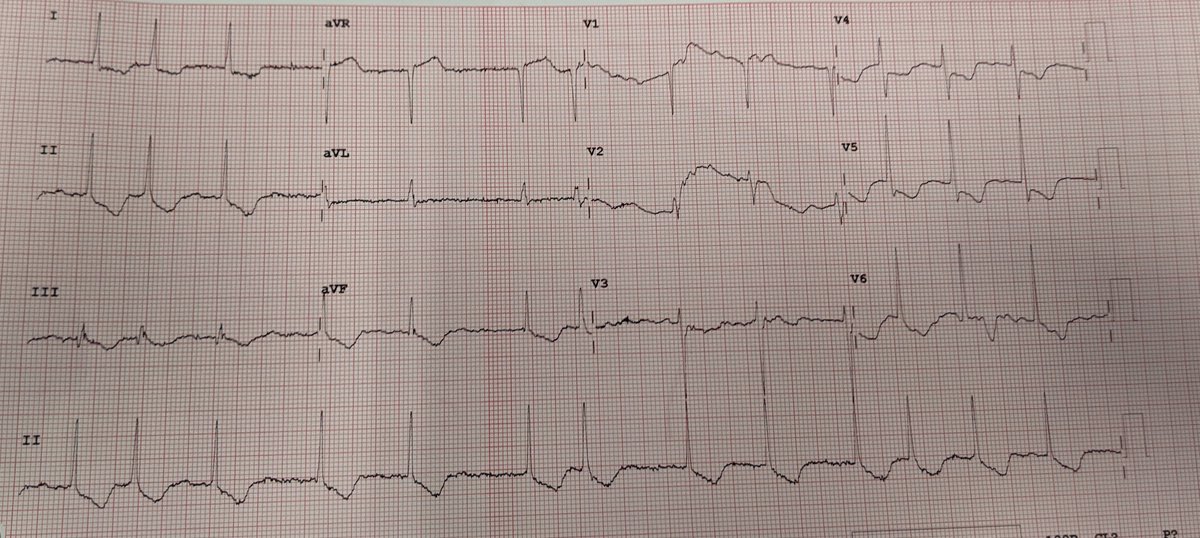 Danidueci's tweet photo. This baselineECG for a pt admitted for rehab (asymptomatic)was handed me yesterday. Go down slow, go up steep STin all leads: thought digoxin toxicity. Cardiologists 1 &amp; 2 made me ask trops (neg). Cardiologist 3 this am, with serum level available"digoxin toxicity". Have a look. https://t.co/MaIn7jO1UG