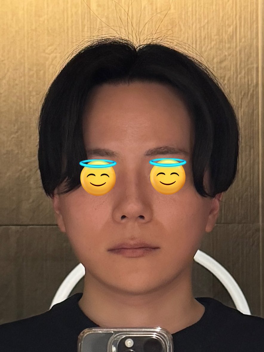 整形社員♂ （輪郭三点、鼻フル、切開リフト） tweet media