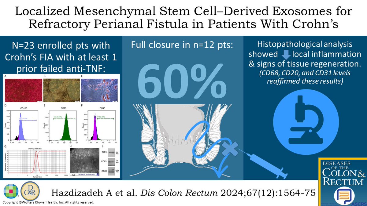 DCRjournal (@dcrjournal) on Twitter photo #DCRJournal Visual Abstract | Localized Administration of Mesenchymal Stem Cell–Derived Exosomes for the Treatment of Refractory Perianal Fistula in Patients With Crohn’s Disease: A Phase II Clinical Trial: bit.ly/3AWcHYo
<a href="/JohnRTMonsonMD/">John Monson MD FRCS FACS FASCRS</a> <a href="/juliomayol/">Julio Mayol</a> #DCRJournal Visual Abstract | Localized Administration of Mesenchymal Stem Cell–Derived Exosomes for the Treatment of Refractory Perianal Fistula in Patients With Crohn’s Disease: A Phase II Clinical Trial: bit.ly/3AWcHYo
<a href="/JohnRTMonsonMD/">John Monson MD FRCS FACS FASCRS</a> <a href="/juliomayol/">Julio Mayol</a>