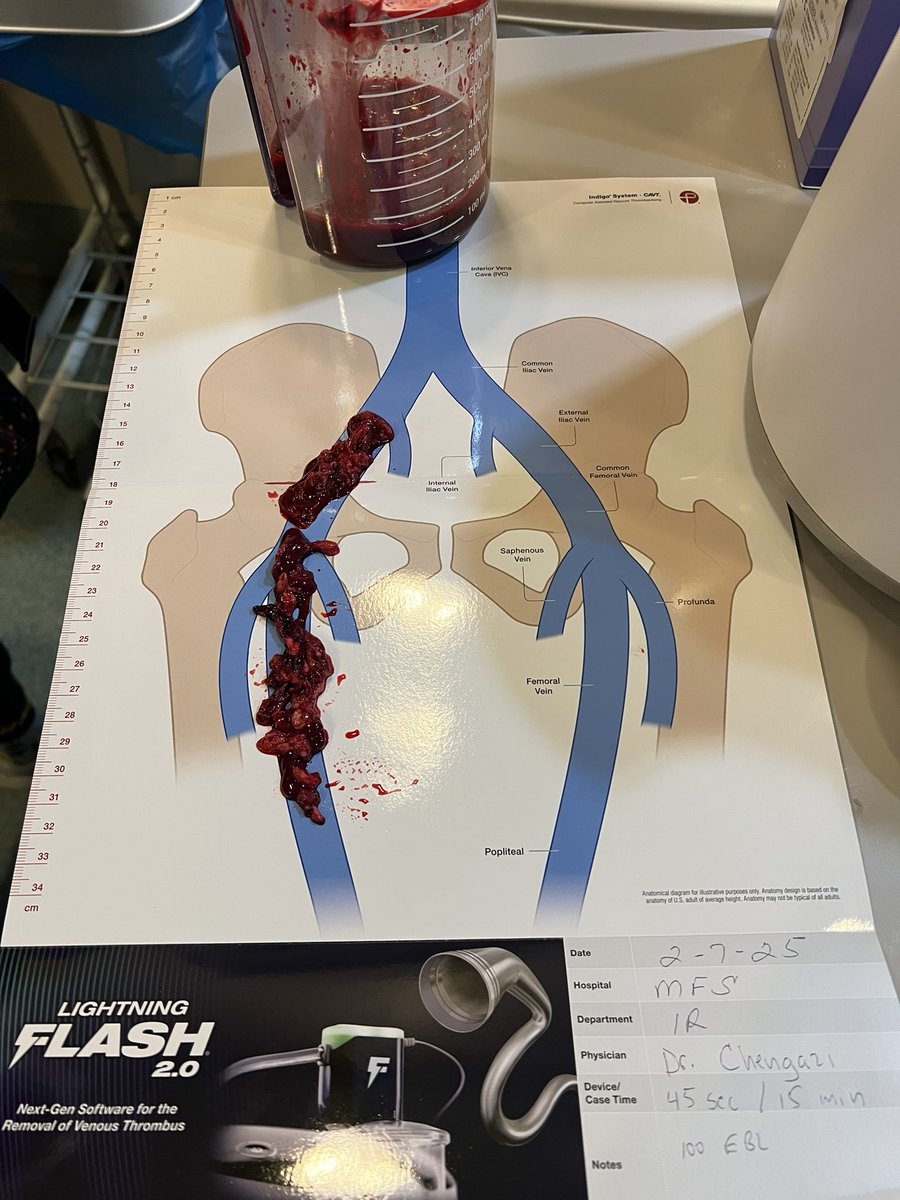Harris Chengazi (@chengazimd) on Twitter photo Acute DVT addressed with <a href="/penumbrainc/">Penumbra, Inc.</a> FLASH 16, <30s fluoro time, 15m room time, 150cc EBL (includes saline however). Acute DVT addressed with <a href="/penumbrainc/">Penumbra, Inc.</a> FLASH 16, <30s fluoro time, 15m room time, 150cc EBL (includes saline however).