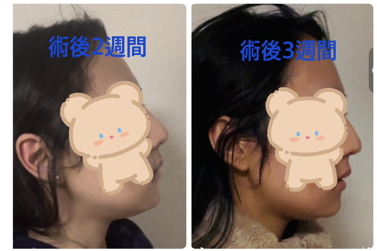 mesuireru_'s tweet photo. 立体美容外科さん（＠ipchejp）で輪郭3点手術を受け、3週間経ちました。

少しずつですが綺麗なフェインラインが出てきて、嬉しいです！

腫れ？なのか顎下がプニプニとした二重顎になっていますが、なくなってさらに綺麗になるのが楽しみです。

＃立体美容外科＃輪郭手術＃渡韓整形 https://t.co/6MPL5tEQSV