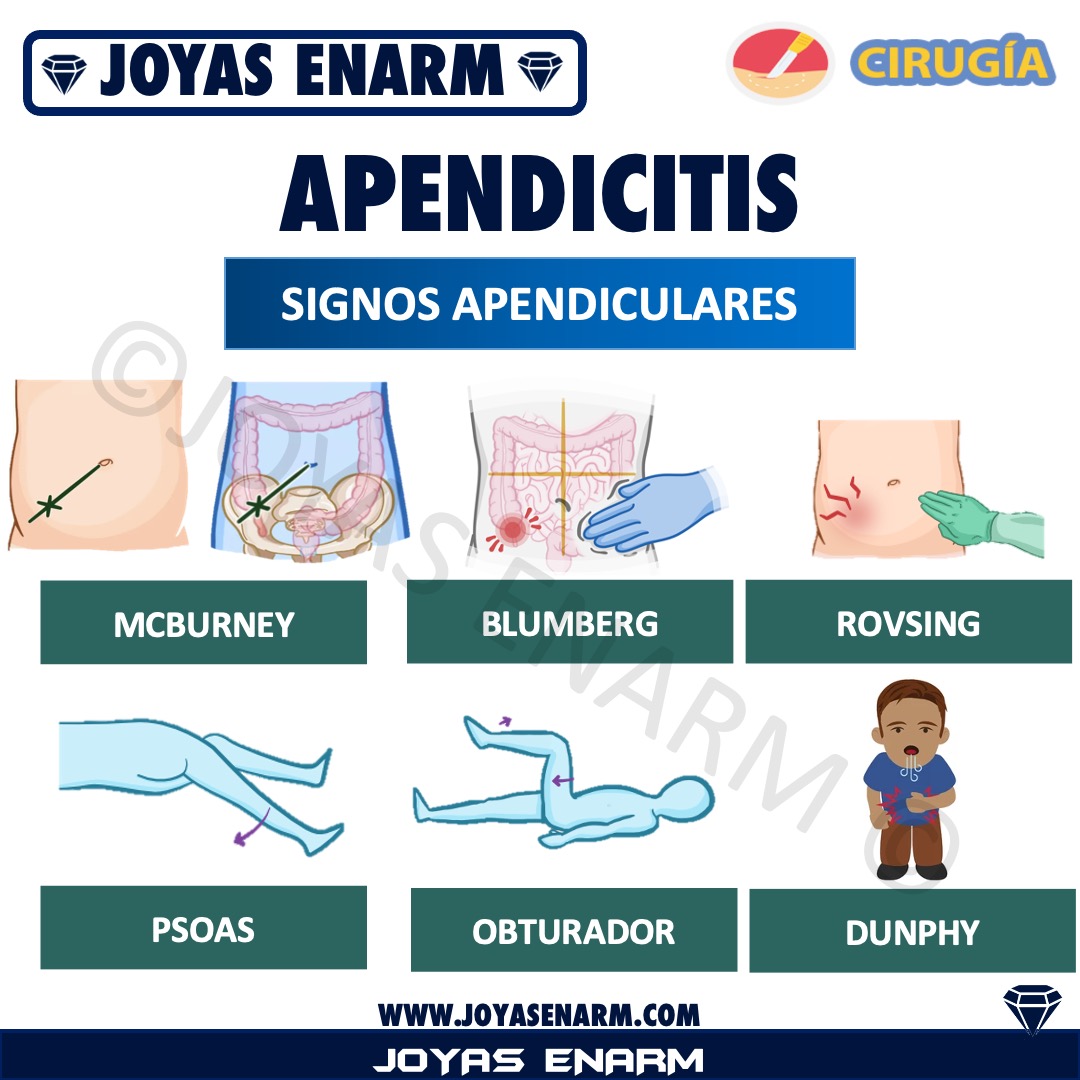 Hilo de signos de APENDICITIS (🧵...) 

Revisa el tema completo en 👉🏻 joyasenarm.com