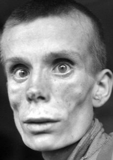 David Jacobs (@drjacobsrad) on Twitter photo The wasting of the temporal muscles and muscles of mastication are signs of advanced cachexia seen with severe starvation as well as with advanced malignancies.
This is no different than what the victims of Auschwitz suffered.
<a href="/FranceskAlbs/">Francesca Albanese, UN Special Rapporteur oPt</a> The wasting of the temporal muscles and muscles of mastication are signs of advanced cachexia seen with severe starvation as well as with advanced malignancies.
This is no different than what the victims of Auschwitz suffered.
<a href="/FranceskAlbs/">Francesca Albanese, UN Special Rapporteur oPt</a>
