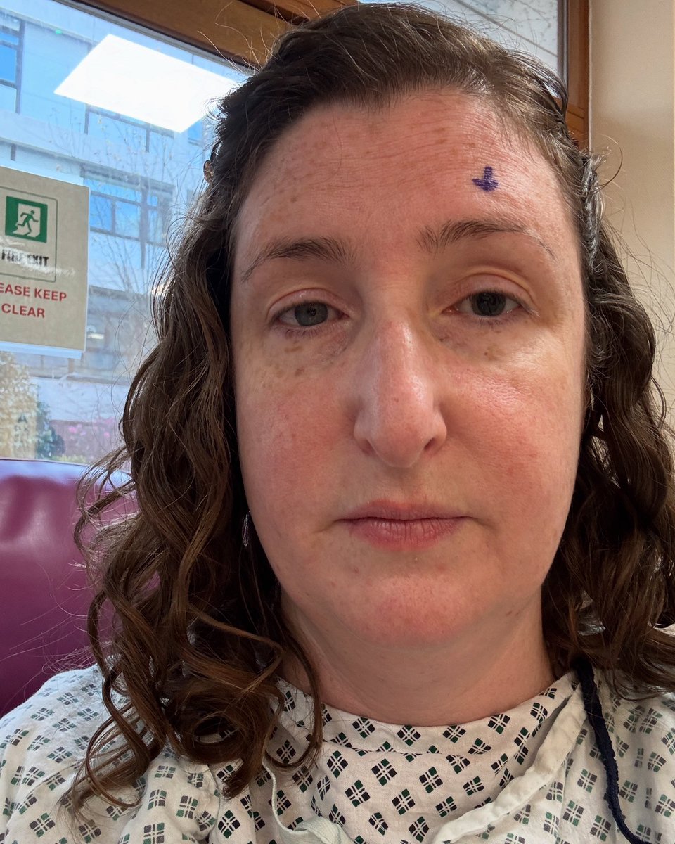 Braunteaches's tweet image. #scleralbuckle #retinaldetachment surgery +3days. Not feeling marvellous tbh and vision is not really there. Fun fun fun but glad for good surgeons