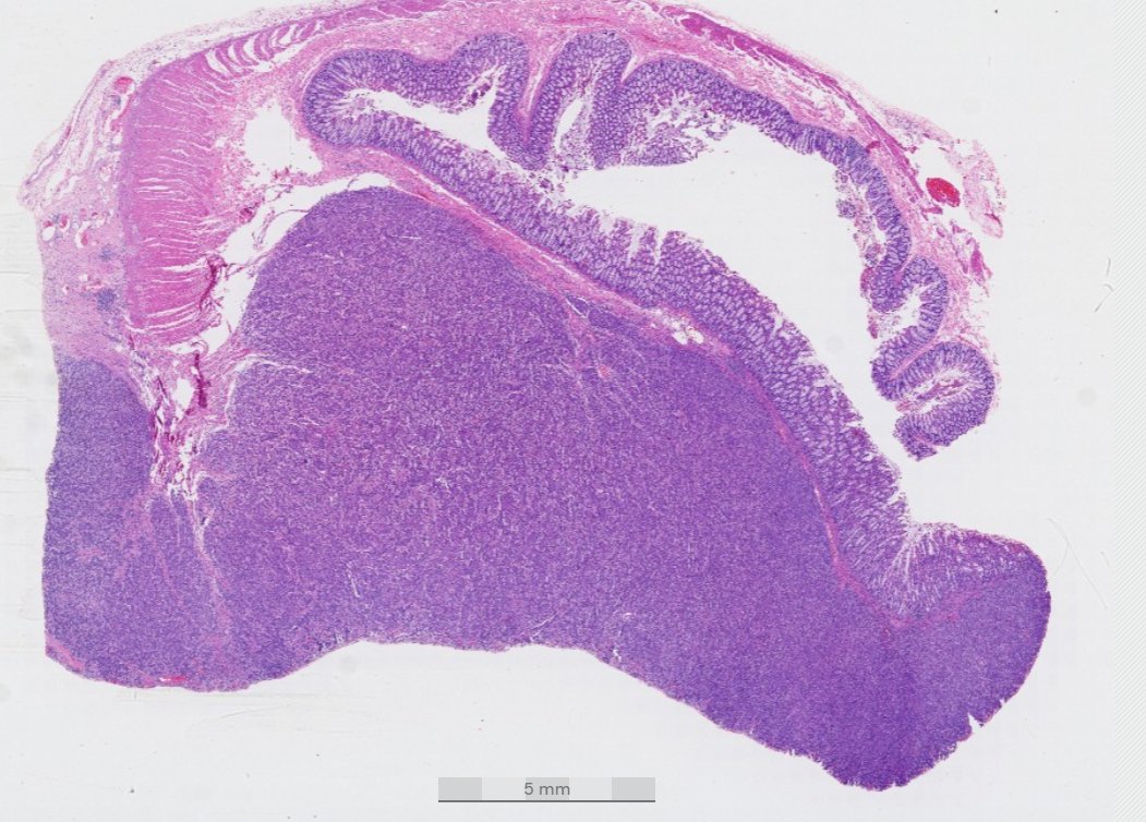 Colon-Subtypes of colorrectal carcinoma
Medullary carcinoma
Interesting facts
-Could be C7 +, CK20 - and calretinin +
-They could be CDX2 and SATB2  negative
-Mismatch repair deficient or proficient

Dr. Gonzalez #USCAP #pathology #PathX #PathTwitter
