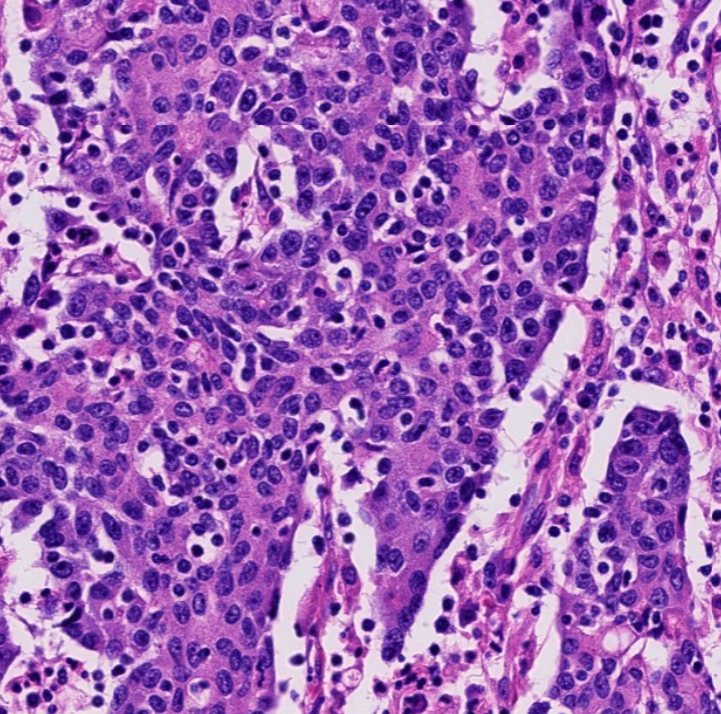 Janiranavarro's tweet photo. Colon-Subtypes of colorrectal carcinoma
Medullary carcinoma
Interesting facts
-Could be C7 +, CK20 - and calretinin +
-They could be CDX2 and SATB2  negative
-Mismatch repair deficient or proficient

Dr. Gonzalez #USCAP #pathology #PathX #PathTwitter