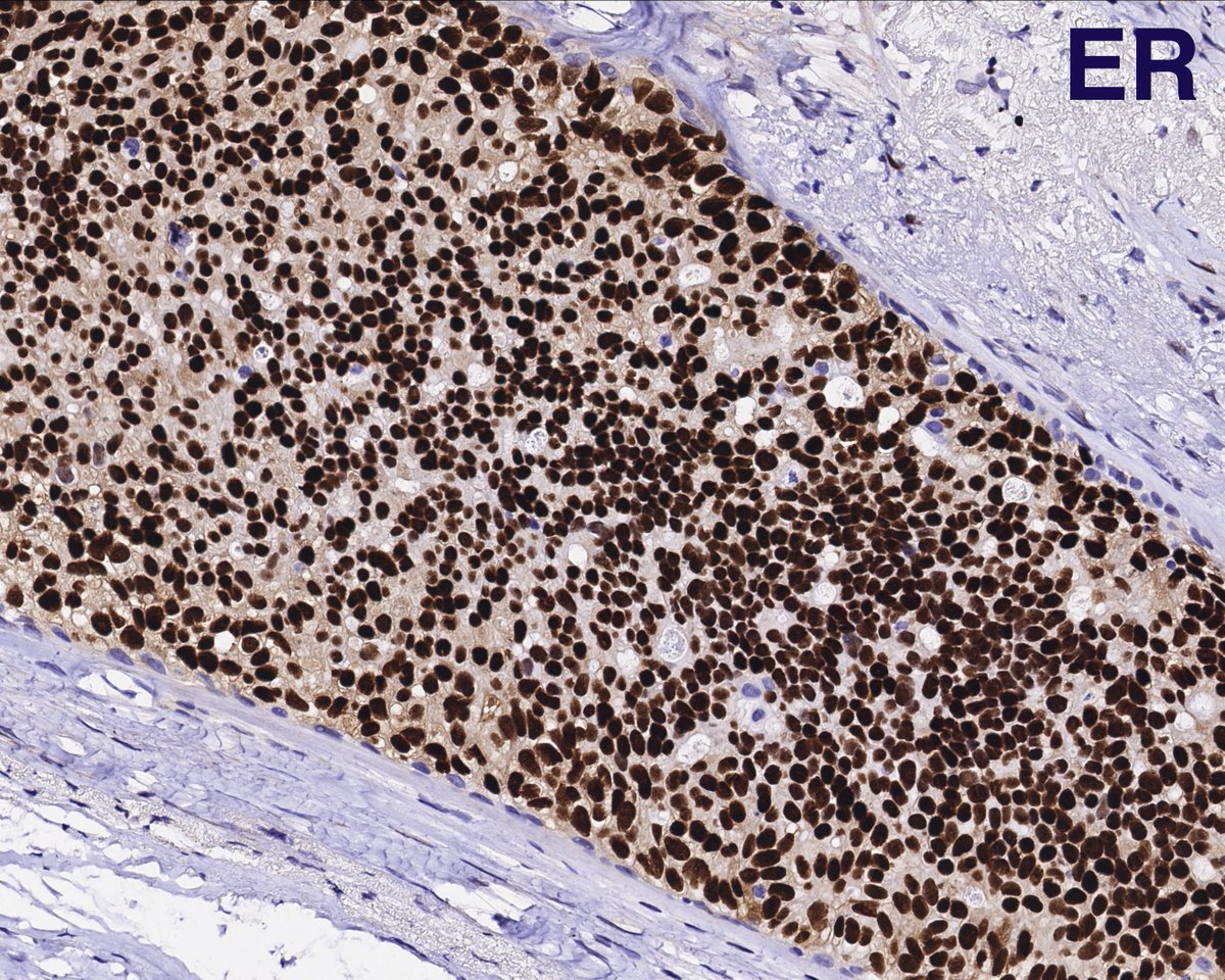 Breast adenomyoepithelioma with papillary intraductal growth and incidental finding of DCIS after IHC #breastpath #insitu #DCIS #adenomyoepithelioma #AME