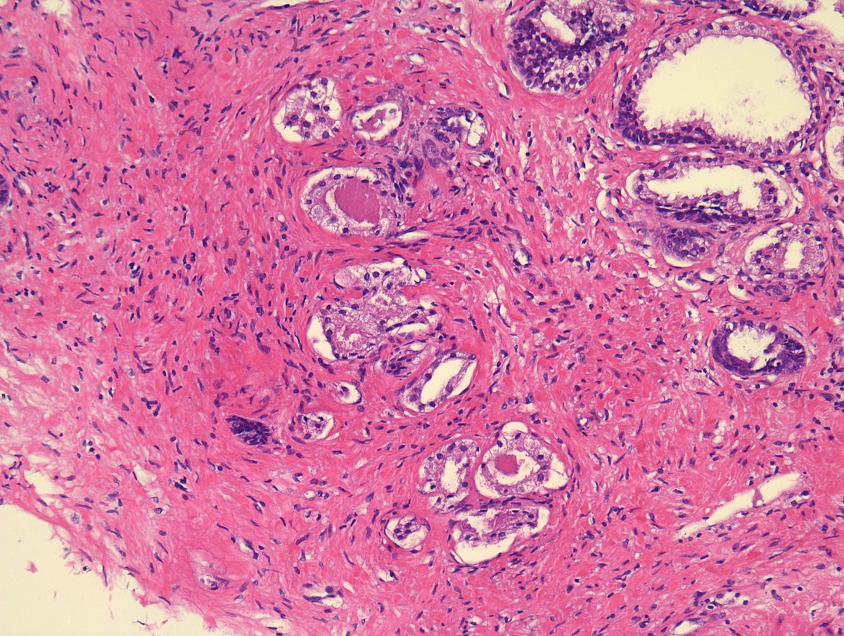 MirunaPopescu13's tweet photo. TURP specimen. M in his 70s. Answer the poll below and test your everyday #GUPath knowledge π
#PathTwitter #pathresidents #pathfellows #uropathology https://t.co/jHgQ5ggEWB