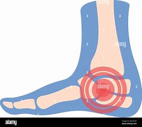 PharmEssence's tweet photo. Say goodbye to heel pain with our all-natural pain balms! fast relief and soothing comfort in every application.  Step into a pain-free life! #heelpain #WellnessJourney #CBD #CBG https://t.co/UKYcfLo5vk