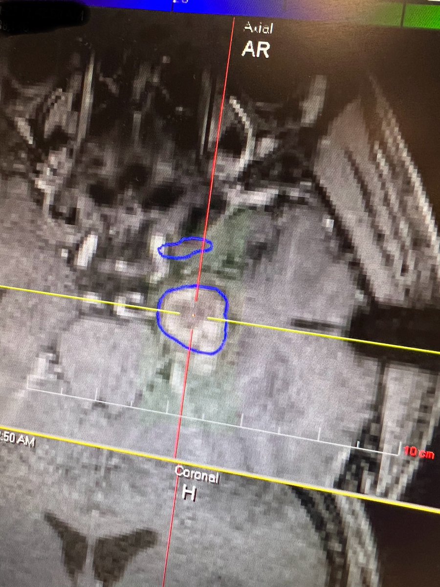 afshin salehi, M.D., M.S., FAANS (@afshinsalehi) on Twitter photo Left image: second trajectory LITT for MTLE after Engel IIIA outcome
Right image: post-LITT DWI scan with ablation of the amygdala, now Engel IIA
Do you do single or multiple trajectory LITT upfront for MTLE ablation?
<a href="/PedsSection/">AANS/CNS Peds Section</a> <a href="/TheASPN/">ASPN American Society of Pediatric Neurosurgeons</a> <a href="/AANSNeuro/">AANS</a> <a href="/CNS_Update/">CNS</a> Left image: second trajectory LITT for MTLE after Engel IIIA outcome
Right image: post-LITT DWI scan with ablation of the amygdala, now Engel IIA
Do you do single or multiple trajectory LITT upfront for MTLE ablation?
<a href="/PedsSection/">AANS/CNS Peds Section</a> <a href="/TheASPN/">ASPN American Society of Pediatric Neurosurgeons</a> <a href="/AANSNeuro/">AANS</a> <a href="/CNS_Update/">CNS</a>
