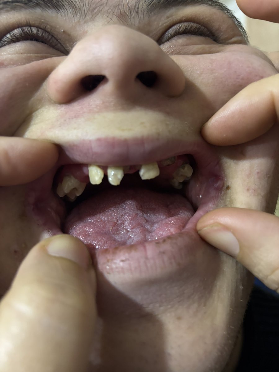 My little brother Ibrahim needs to undergo an urgent surgery.

He suffers from severe pain that he cannot bear and difficulty in chewing food, so he needs a delicate surgery with general anesthesia 

Please help us in providing the transaction amount 😔

gofund.me/c934e557