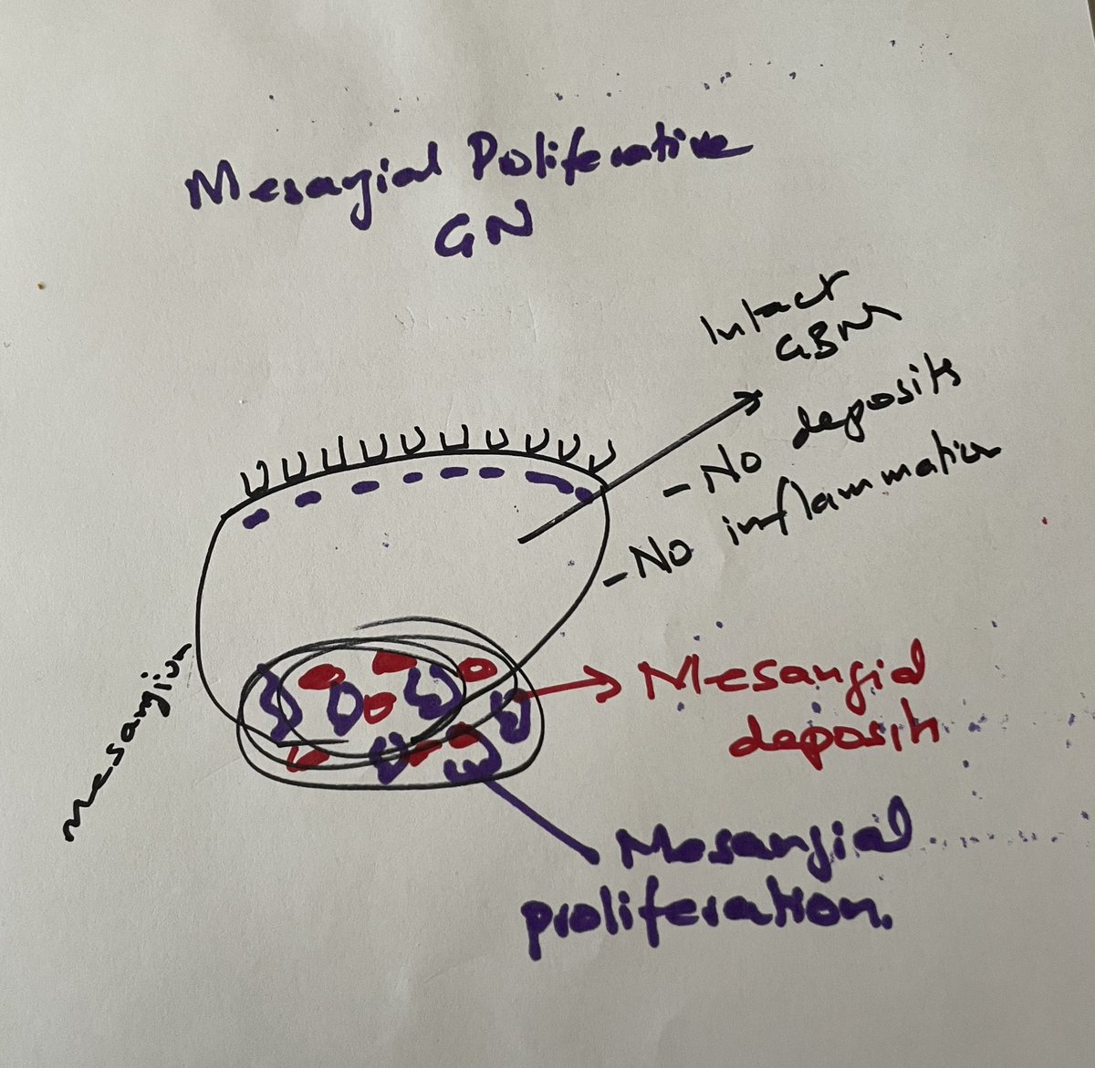 Basics of Glomerulonephritis (GN). GBM is key.

All patterns can be explained by glomerular basement...