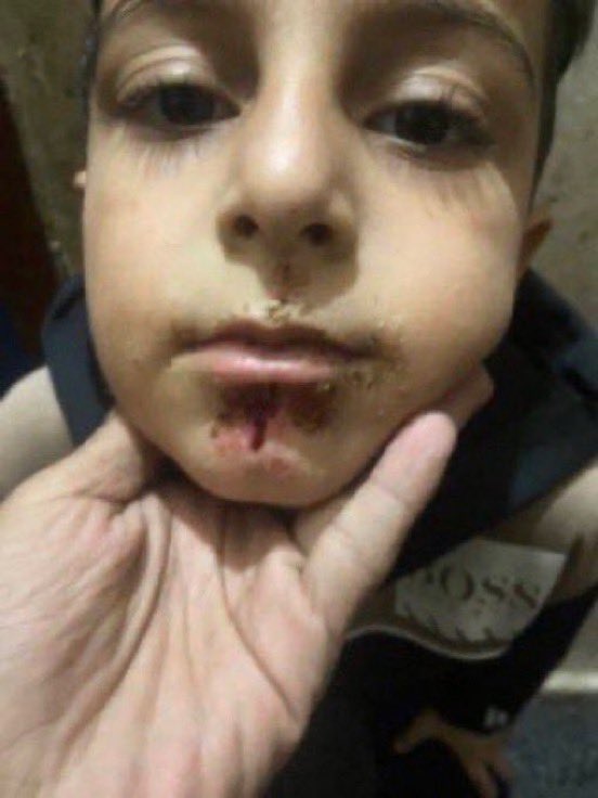 Urgent‼️
My little brother Omar is infected with a bacterial infection and severe infections in his face and suffers from stomach pain due to water,air,and contamination of unhealthy food.He helped us get help through donation and participation to save him
gofund.me/28a650ab
