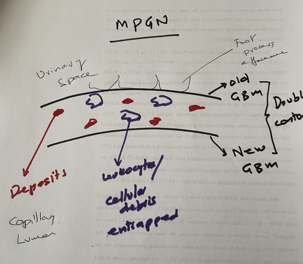 Membranoproliferative GN (MPGN)

1. Original GBM stays INTACT 

2. + New GBM made, entrapping immune/complement

3. Results in 2 GBM: original &amp; new= double contour 

4. Double contour results in ⬇️ leukocytes=⬇️ inflammation

Seen in chronic disease:hepatitis, monoclonal Ig, C3G