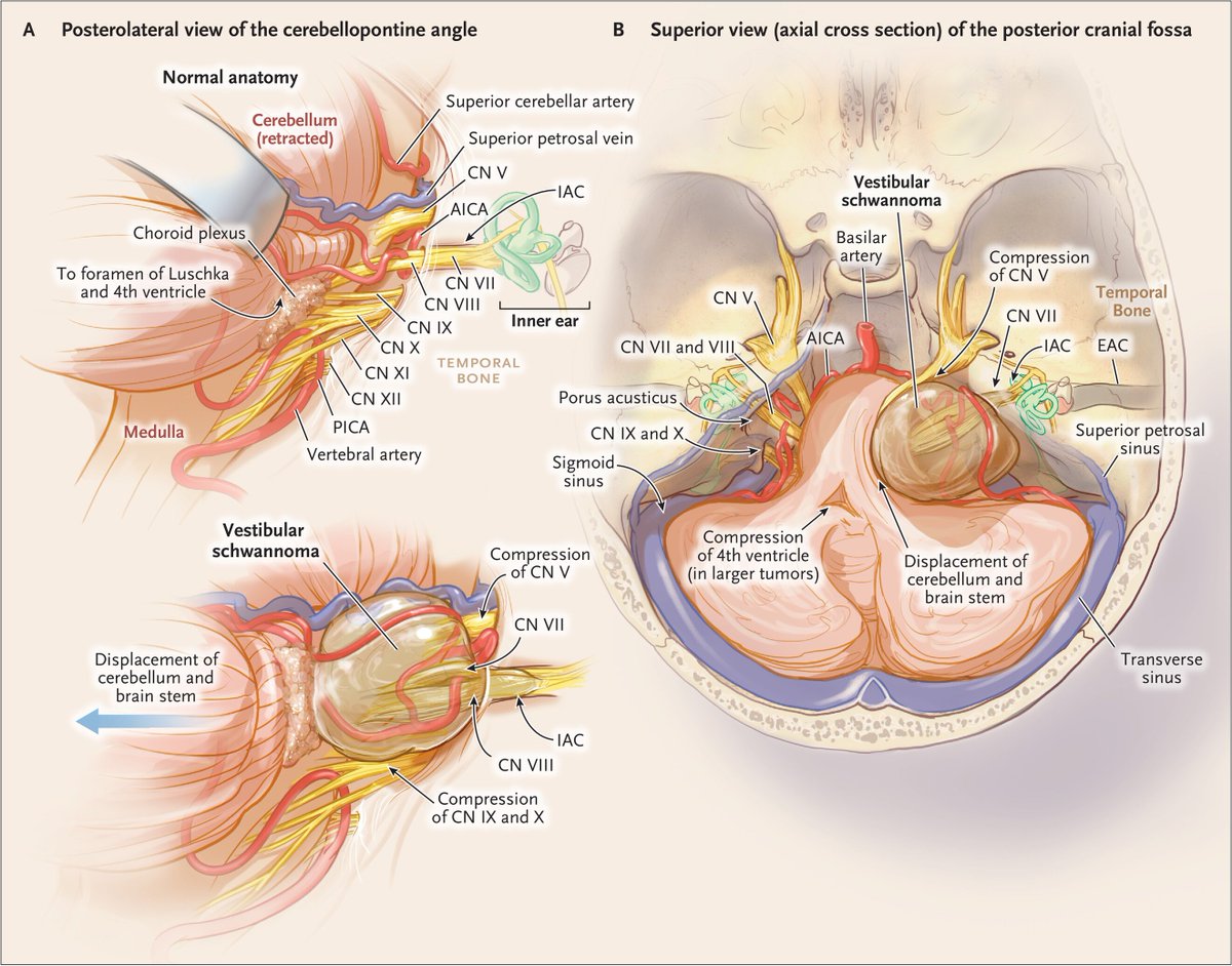 🧵 Vestibular Schwannomas: Classification, Treatment &amp; Surgery
1/ What is a Vestibular Schwannoma?
🧠 A benign, slow-growing tumor from Schwann cells of CN VIII (vestibular nerve).
📌 Located in the cerebellopontine angle (CPA)
📌 Can cause hearing loss, tinnitus, imbalance, and