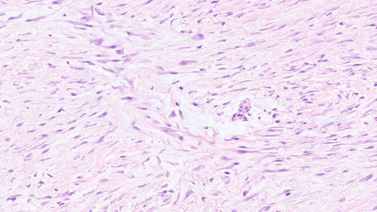 Desmoid fibromatosis can sometimes exhibit histologic features which overlap with nodular fasciitis, including focal areas of a more haphazard spindle cell arrangement. #BSTpath, #UMichPath, #BSTpathGoBlue