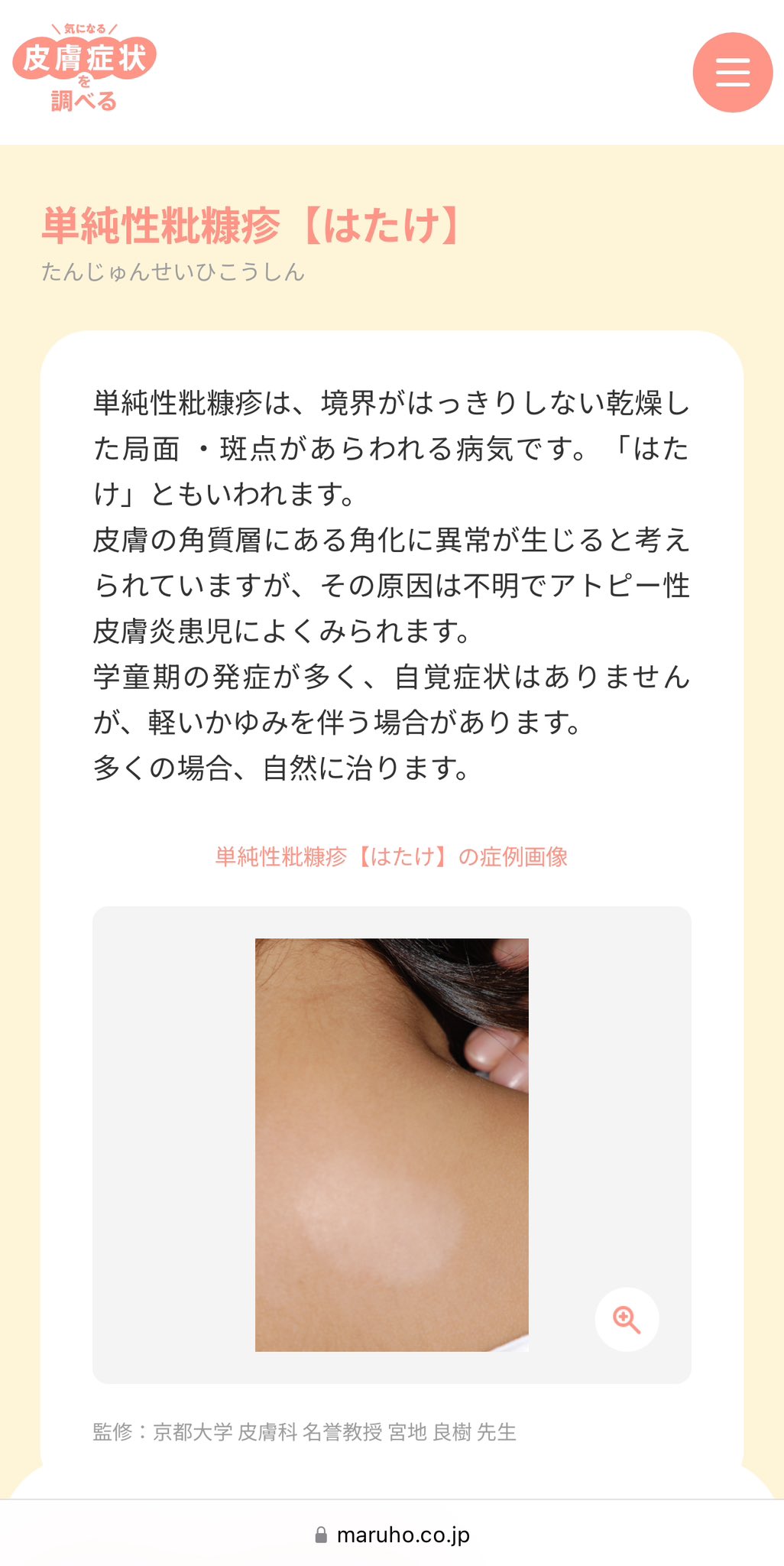 SoS@皮膚科専門医試験対策編 on X: 皮膚科のこの種のやつで一番謎なのは 「単純性粃糠疹、いわゆるはたけ」 だと思います  俗称を言っても伝わりづらいけど、医学的名称はさらにわからないという… t.coeLuBGzOE9D  t.coEKEwLxWOSr  X