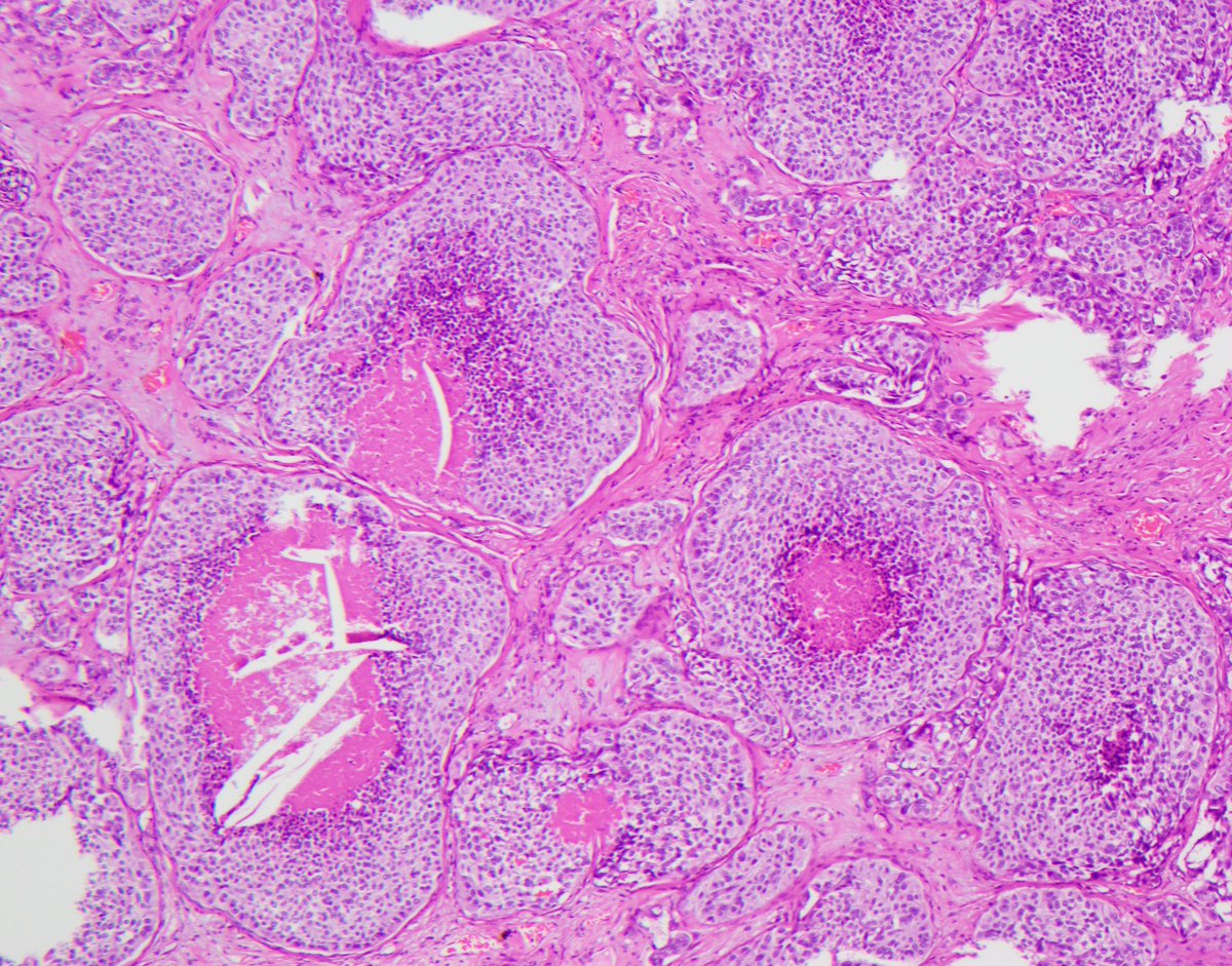 CaDxPath's tweet image. Infarct necrosis important to separate from true tumour necrosis in NETs.2 show true necrosis(abrupt transition, karyorrhectic debris, comedo-like)&amp;amp; 2 show infarct(gradual transition, zonal granulation tissue/myobroblasts)

If you think easy -&amp;gt; retweet
If you think hard -&amp;gt; like