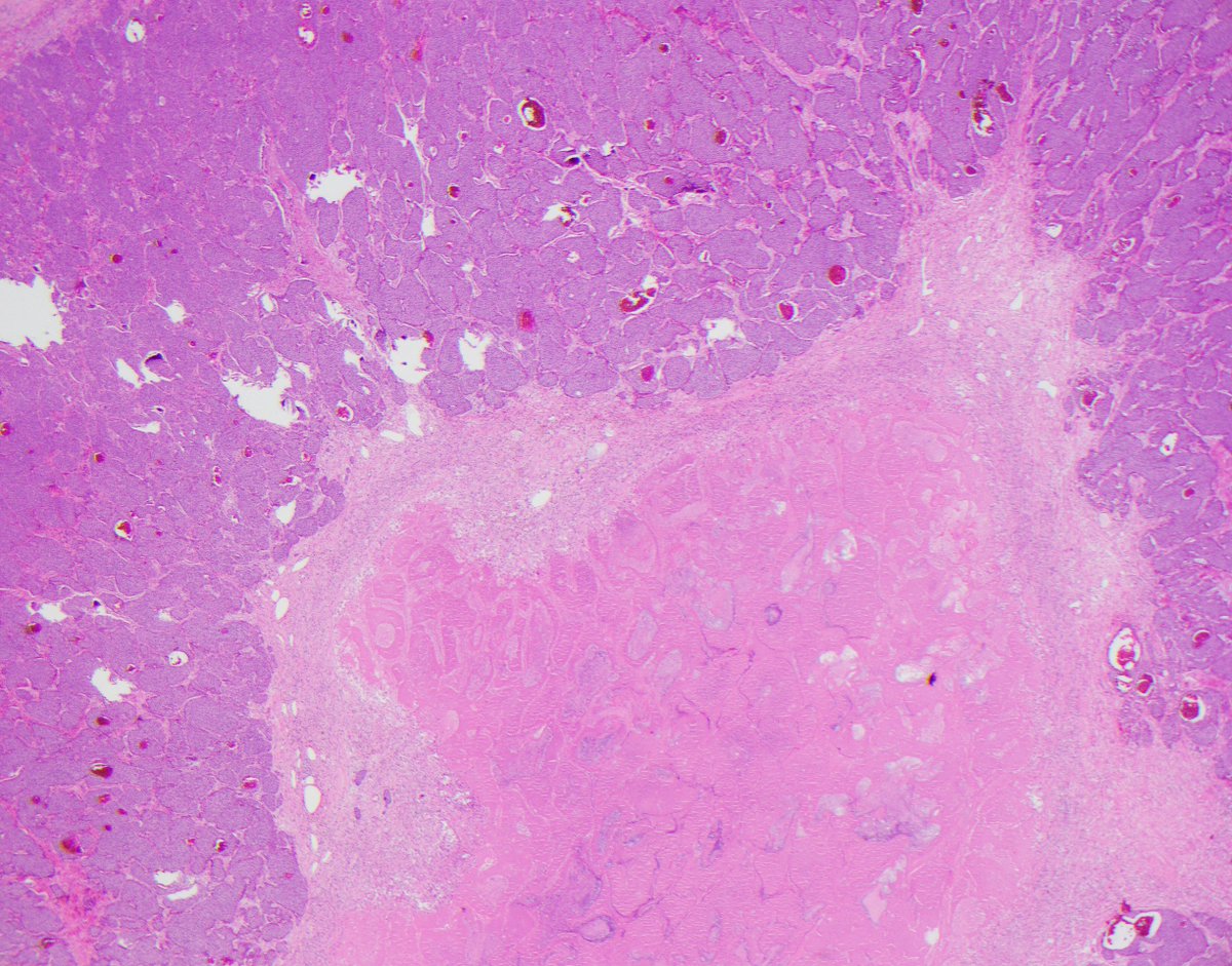 CaDxPath's tweet image. Infarct necrosis important to separate from true tumour necrosis in NETs.2 show true necrosis(abrupt transition, karyorrhectic debris, comedo-like)&amp;amp; 2 show infarct(gradual transition, zonal granulation tissue/myobroblasts)

If you think easy -&amp;gt; retweet
If you think hard -&amp;gt; like