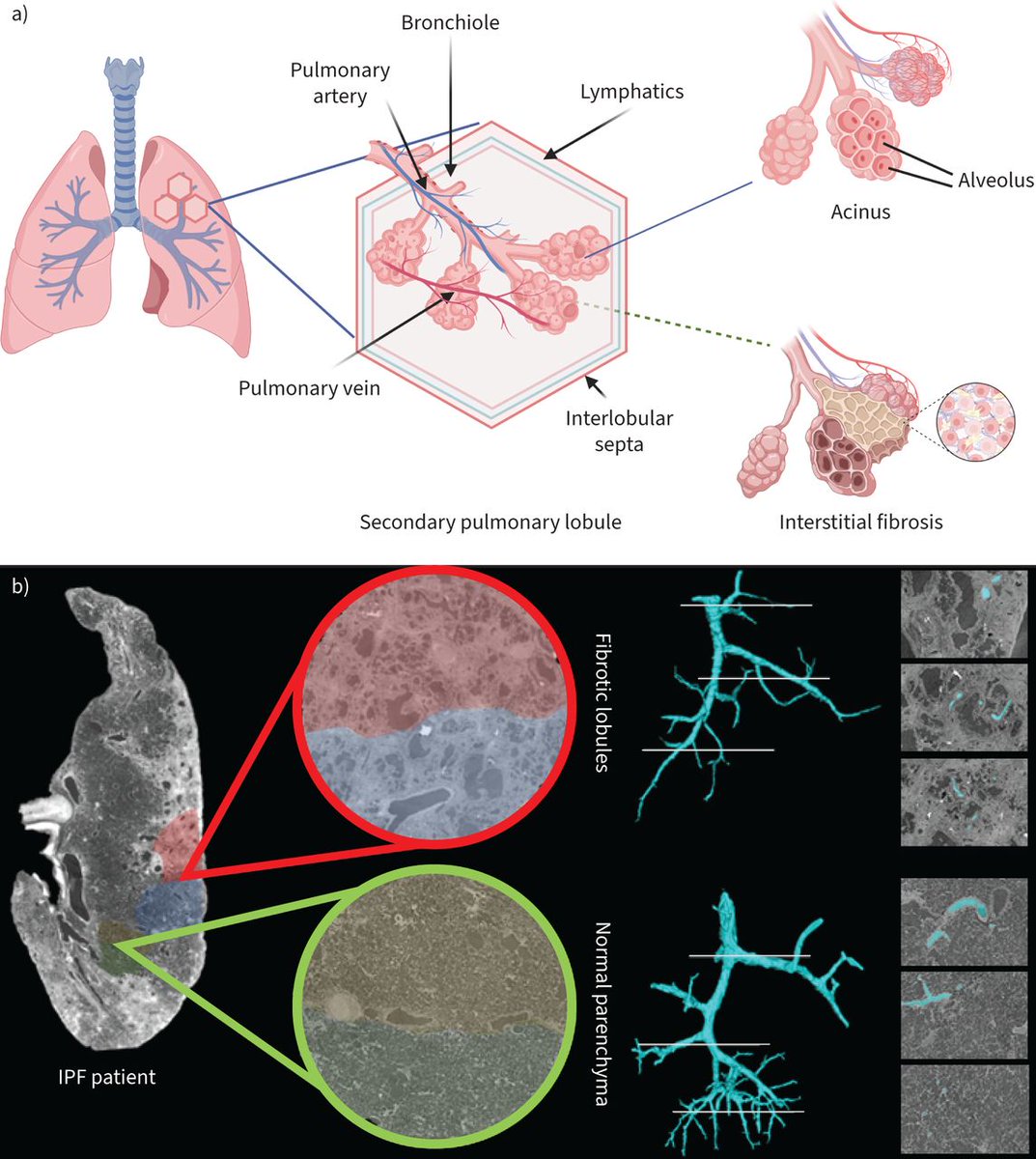 ERR: A review presenting our current understanding of the role of vascularity in the pathogenesis of interstitial lung diseases, emphasising its potential contribution to the exacerbation of fibrosis and its therapeutic implications. bit.ly/3NLn4Rg