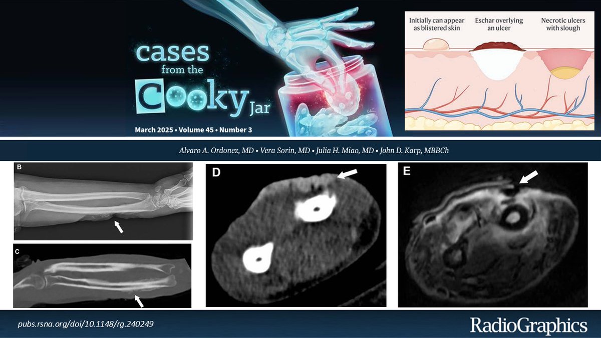 Patient with extensive wounds on the right arm💪, with exposure of the muscle🤕
Diagnosis❓

Answer: 🔗pubs.rsna.org/doi/10.1148/rg…

Have a companion case? Share using #CookyBites #203 and we will RT the best cases!
<a href="/cookyscan1/">Cooky Menias</a> <a href="/RadioGraphics/">RadioGraphics</a> #RGphx