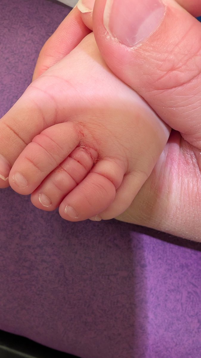 NightHaunter's tweet photo. Ça arrive notamment après l'accouchement avec l'effluvium telogene de maman qui va perdre plein de cheveux suite à la chute hormonale. 

Mais ça peut concerner les plus grands jusque 2 ans parfois. 

Alors soyez vigilants (et inspectez sous la chausette et la couche) https://t.co/IKMegdrm5z