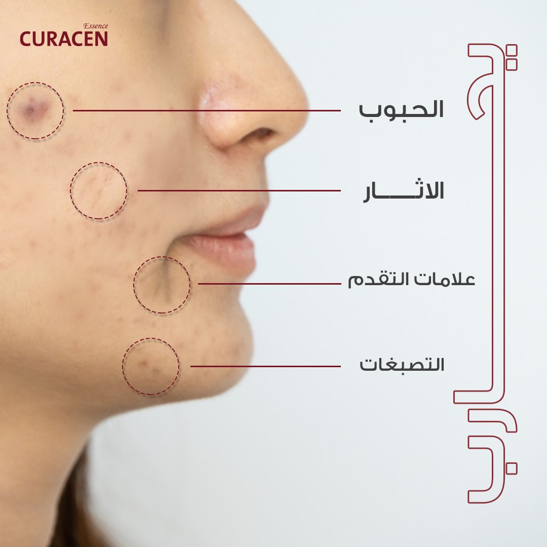 Dermacity_Ksa's tweet photo. يساعد كيوراسين على مكافحة حب الشباب، تقليل المسام الواسعة، والتخلص من الآثار والندبات بفضل تركيبته الطبيعية المدعومة بتقنية النانو المتطورة، التي تتيح للمواد الفعالة التغلغل داخل البشرة ومعالجتة مشكلاتها.

#Curacen #تجديد_البشرة #نضارة_الوجه #عناية_بالبشر
#إزالة_الندبات https://t.co/GSyZafJKGv