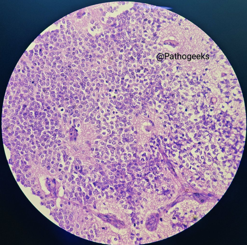 Pathogeeks's tweet photo. 42yr female with intraventricular mass, c/o headache, vomiting.
Diagnosis?
#PathTwitter #pathx #pathology https://t.co/SJZ8gTEAdZ