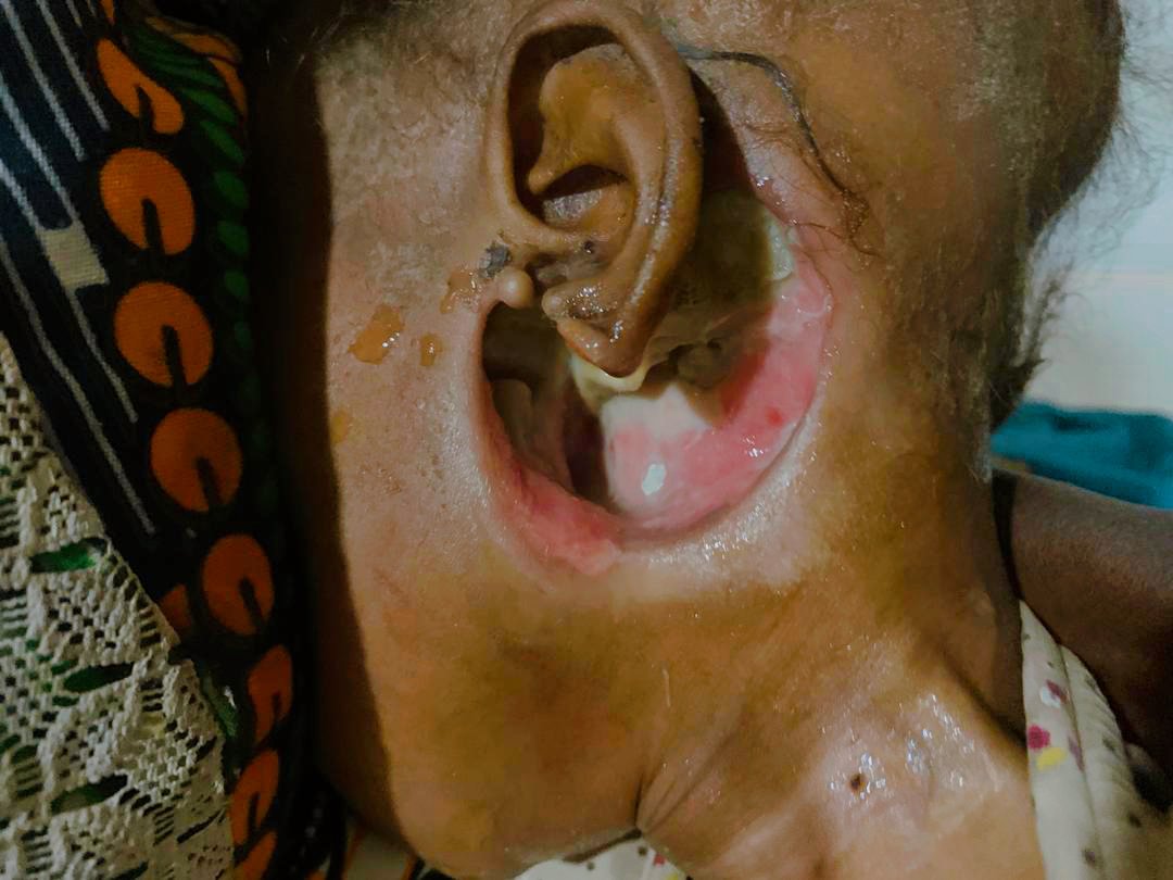 This is a heartbreaking case of a baby in northern Nigeria suffering from necrotizing fasciitis of the auricle, a condition that could have been prevented with timely medical care.
Health awareness saves lives! 

#HealthForAll #MedicalOutreach #SaveALife #WholenessHome