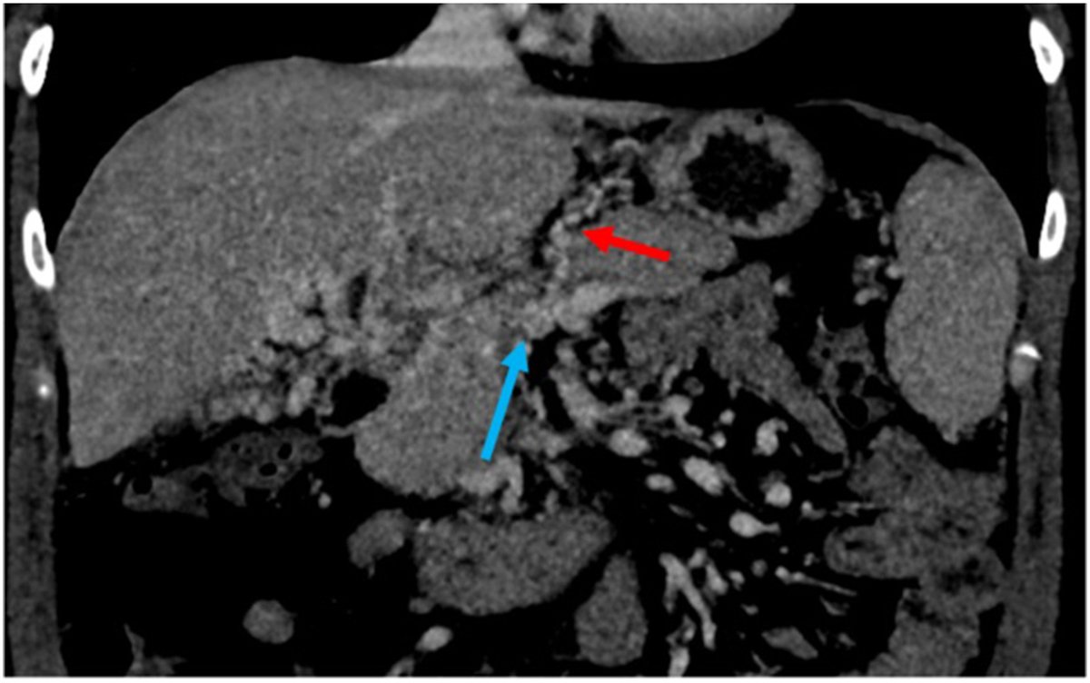 From GHA ➡️ This case report shows that pregnancy in the setting of portal vein thrombosis and cavernoma formation is a high-risk medical condition.  

📖 Read it now! #OpenAccess

👨‍🔬 <a href="/riadsalemIR/">Riad Salem</a>, <a href="/NorthwesternIR/">NorthwesternIR</a>

🔗 ow.ly/Ntbv50UVomz