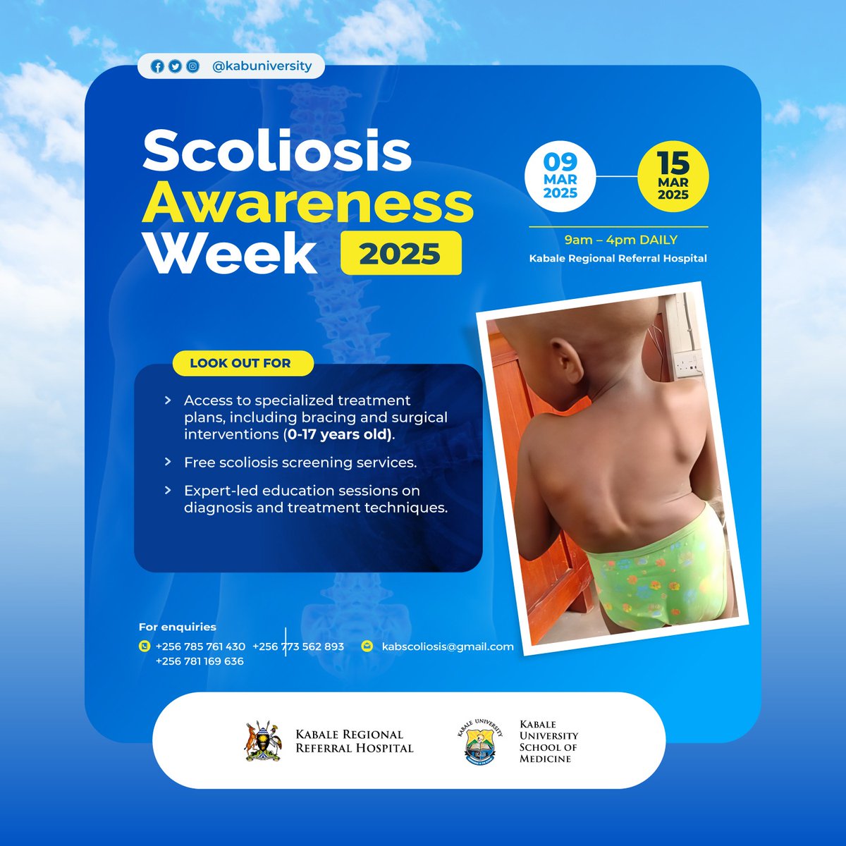 kabuniversity's tweet photo. In collaboration with Kabale Regional Referral Hospital, the Department of Orthopaedics at Kabale University School of Medicine invites you to Scoliosis Week from 9th to 15th March 2025.  Please visit our website for more information: https://t.co/g4ZudwzNBX https://t.co/SUk06zY8lF