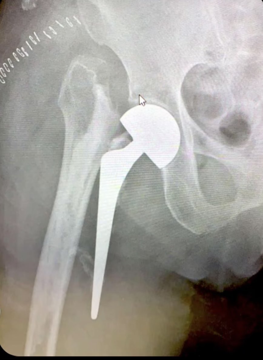 MoAImam's tweet photo. Not dislocated at least!!! https://t.co/bo3BbAxsap