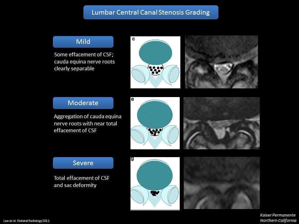 EhabRef48805806's tweet photo. Spinal pearls : 
-Grades of cervical &amp; lumbar central canal + neural foraminal stenosis : 
mild , moderate, sever https://t.co/p0BOJPpqTp