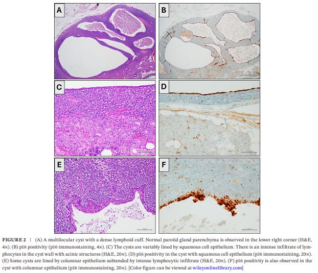 Diagnostic Cytopath (@diagnosticcyto) on Twitter photo #OpenAccess in our #march2025 issue
Application of #HPV-DNA Test on Salivary #FNA Demonstrates for the First Time Its Presence in Salivary Intraglandular Cysts
onlinelibrary.wiley.com/doi/10.1002/dc…
<a href="/IACytology/">International Academy Cytology</a> <a href="/PapSociety/">Papanicolaou Society</a> <a href="/aakasharmand/">Zubair Baloch</a> <a href="/Baskotacytopath/">Swikrity U Baskota,MD, FCAP</a> <a href="/PoonamVohra3/">Poonam Vohra MD</a> <a href="/GokozanMD/">Hamza Numan Gokozan</a> #OpenAccess in our #march2025 issue
Application of #HPV-DNA Test on Salivary #FNA Demonstrates for the First Time Its Presence in Salivary Intraglandular Cysts
onlinelibrary.wiley.com/doi/10.1002/dc…
<a href="/IACytology/">International Academy Cytology</a> <a href="/PapSociety/">Papanicolaou Society</a> <a href="/aakasharmand/">Zubair Baloch</a> <a href="/Baskotacytopath/">Swikrity U Baskota,MD, FCAP</a> <a href="/PoonamVohra3/">Poonam Vohra MD</a> <a href="/GokozanMD/">Hamza Numan Gokozan</a>