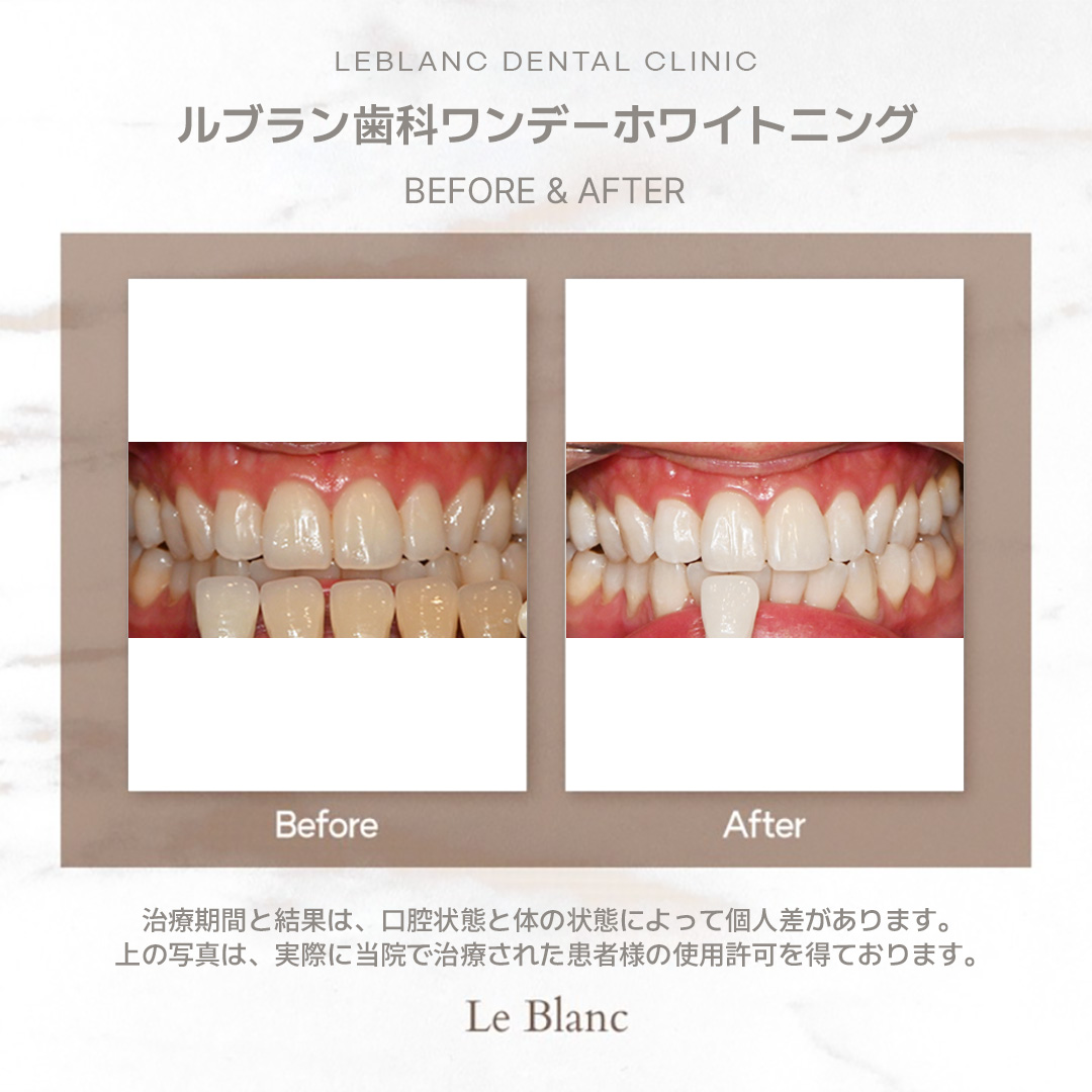 白い歯は美しい笑顔の基本🦷✨ #ルブラン歯科 の #ワンデーホワイトニング は 美白レーザーを3回にわたって照射するため  ホームケアでは難しい確実なホワイトニング効果を 体感していただけます😍 #韓国歯科 #ホワイトニング 📍お問い合わせは公式LINEより  https://t.co ..., image size:1080x1080