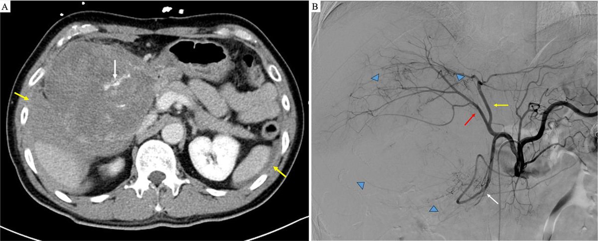 FrontGastro_BMJ's tweet image. #HPB #InsideView #onlinefirst in FG!

EUS-FNA is widely considered safe, but in this case of primary HCC resulted in massive haemorrhage - could positioning digital subtraction angiography earlier have helped with diagnosis?

fg.bmj.com/content/early/…

@sheiybani @PhilSmithIsBack…