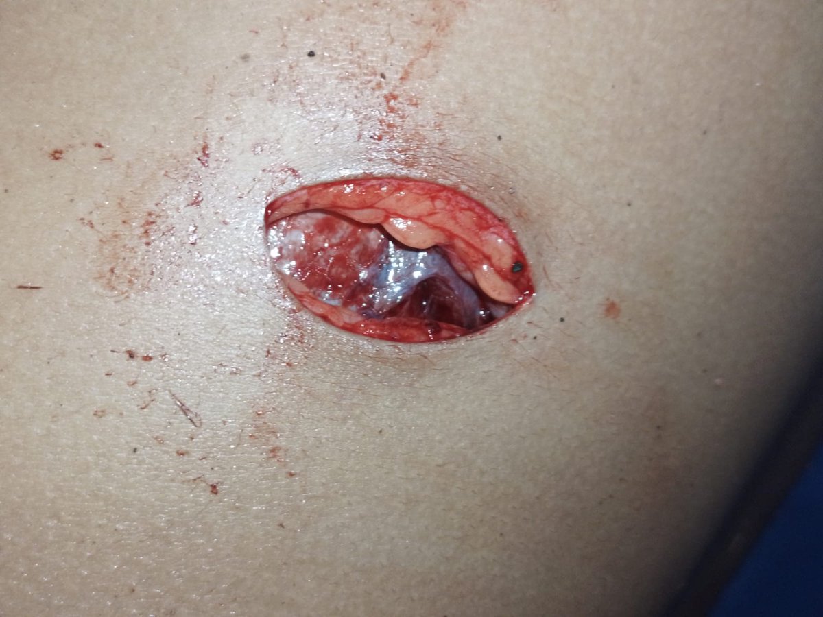 anomalireply's tweet photo. bukti luka tusukan yang disebabkan oleh pelaku E ( 13 thn ), terdapat 3 tusukan di bagian pinggang, punggung dan paha belakang ( tidak ada foto karena diketahui dari hasil otopsi ) https://t.co/qh3boWzEnQ