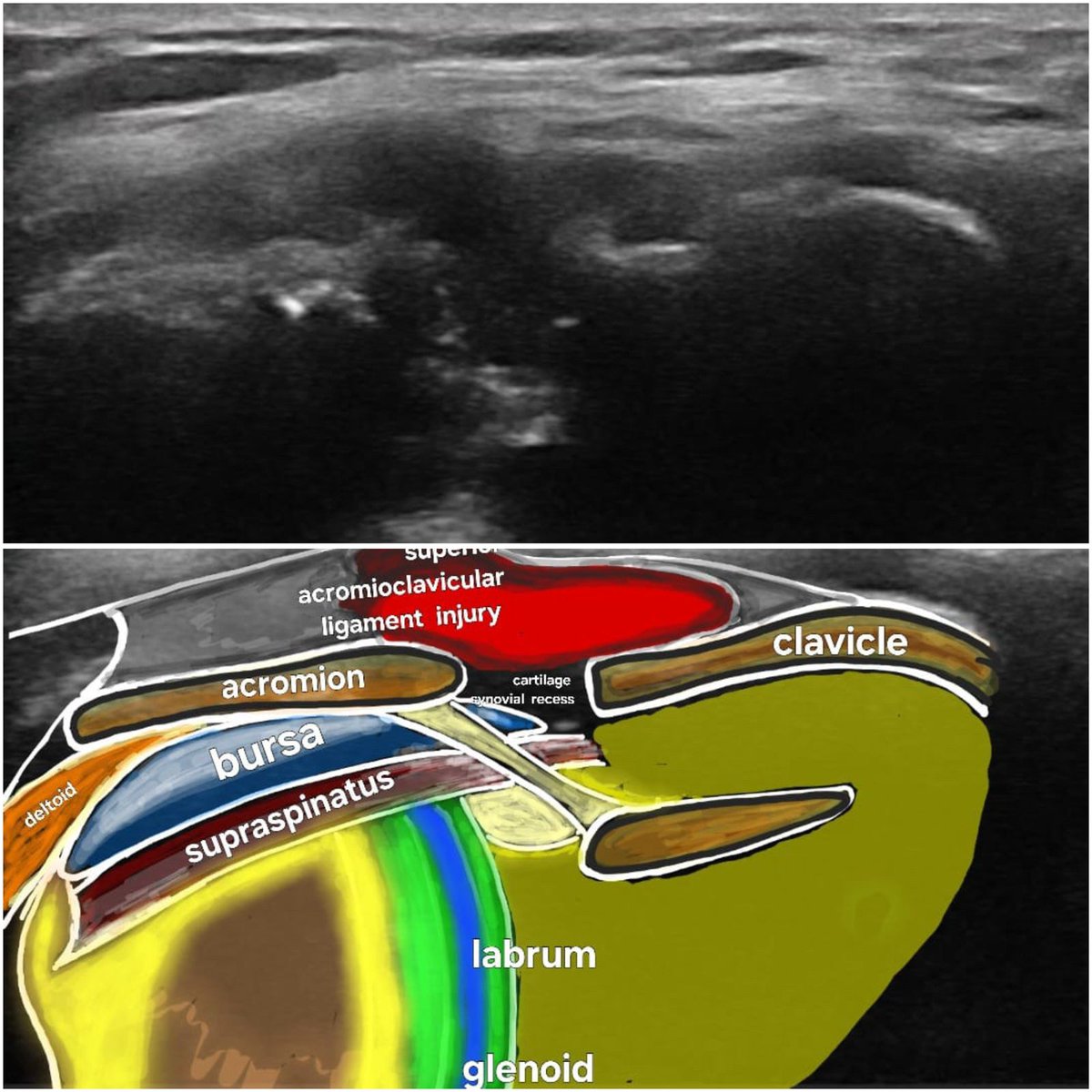 acromioclavicular ligament tear
&amp;sonoanatomy